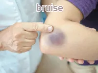 Definition & pronunciation of bruise