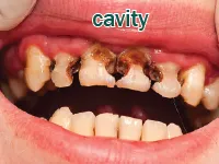 Definition & pronunciation of cavity