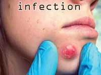 Definition & pronunciation of infection