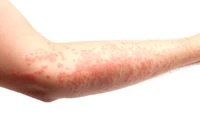 Definition & pronunciation of rash